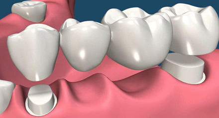 Dental bridge, teeth treatments