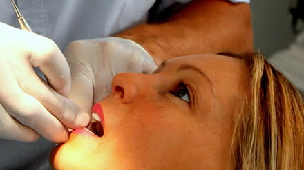 teeth cleaning dental Idea, Swedish Dentists Costa del Sol